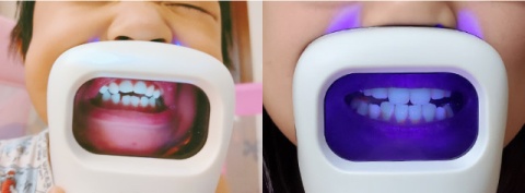 i-Cute innowacyjny skaner czystości zębów do użytku domowego - biały