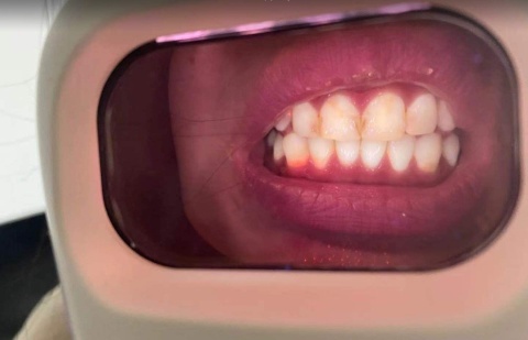 i-Cute innowacyjny skaner czystości zębów do użytku domowego - biały