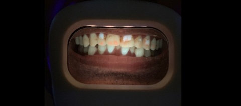 i-Cute innowacyjny skaner czystości zębów do użytku domowego - biały