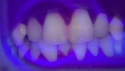 i-Cute innowacyjny skaner czystości zębów do użytku domowego - biały