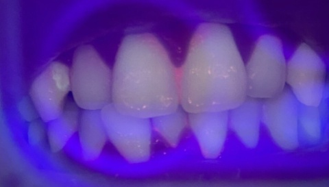 i-Cute innowacyjny skaner czystości zębów do użytku domowego - różowy